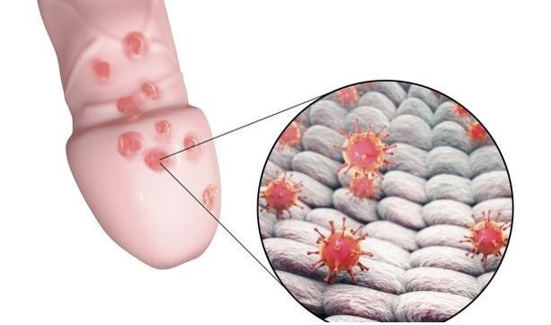 alerģija pret dzimumlocekļa paplašināšanas želeju