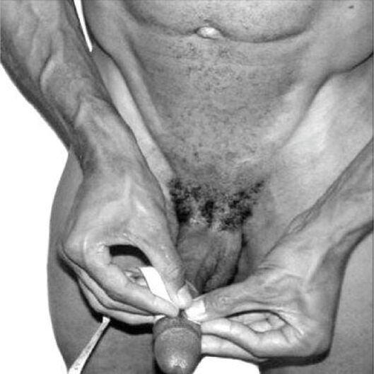 dzimumlocekļa mērīšana pirms paplašināšanas